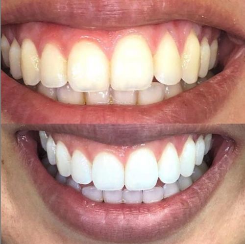 Avant / après SmileFlash
