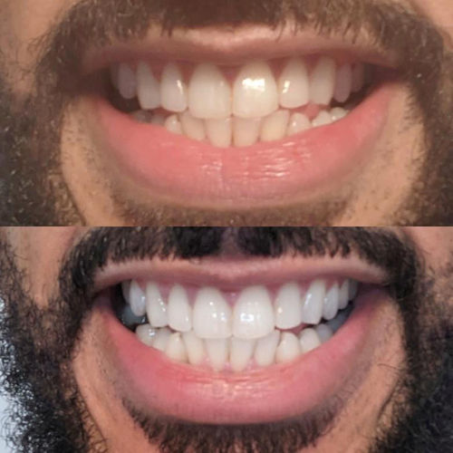 Avant / après SmileFlash